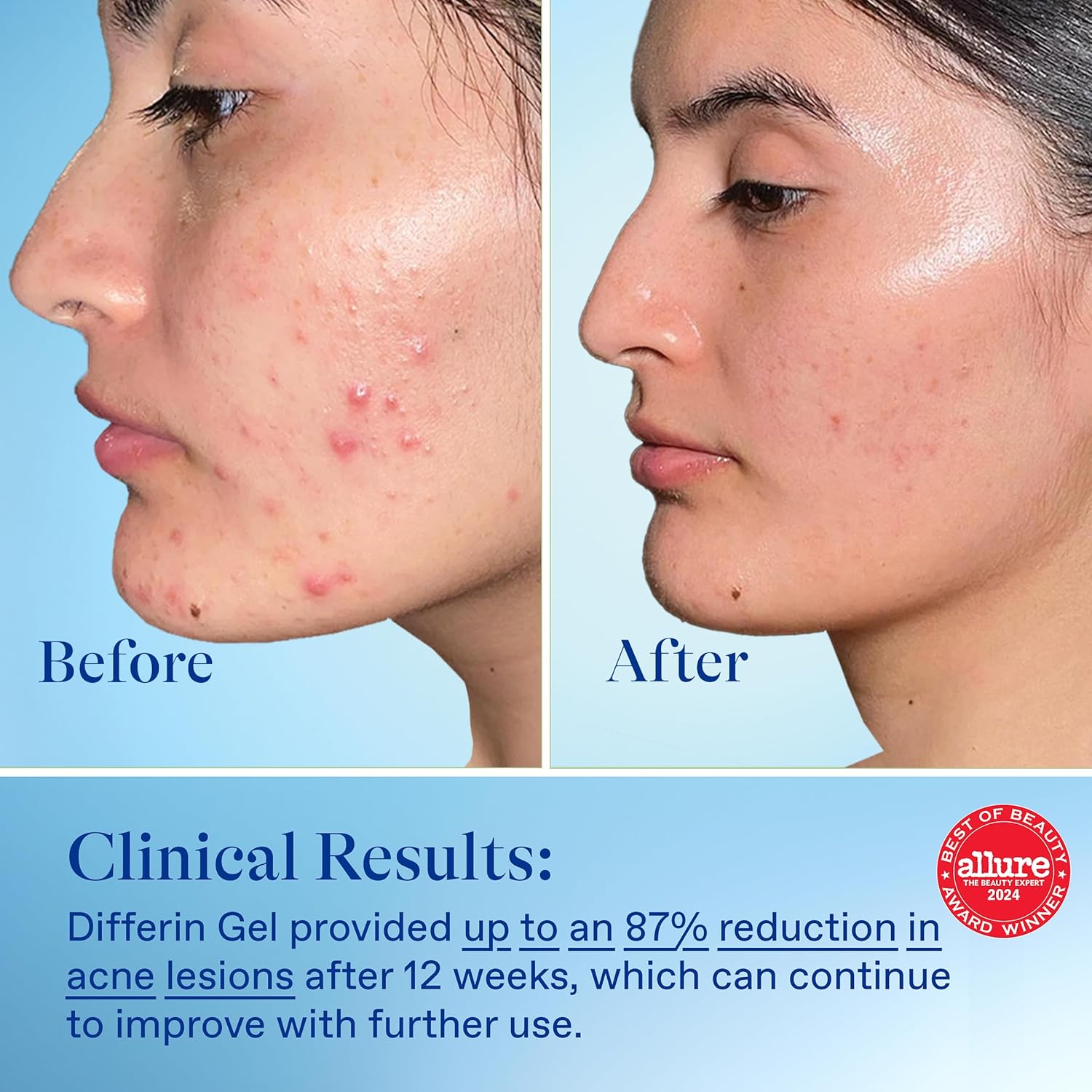 Differin Acne Treatment Gel, 90 Day Supply, Retinoid Treatment for Face with 0.1% Adapalene - Image 3